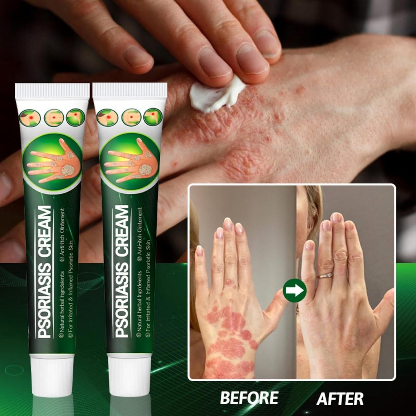 Psoriasis Cream (Original) – 20g
